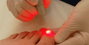 Laser treatment for fungal toenail