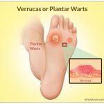 Verrucas or Plantar Warts