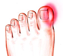 Ingrown Toenail Infection: redness, swelling, tenderness