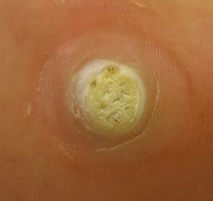 HPV Plantar Wart Treatment in Midtown NYC