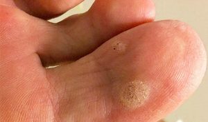 HPV Plantar Wart Treatment in NY