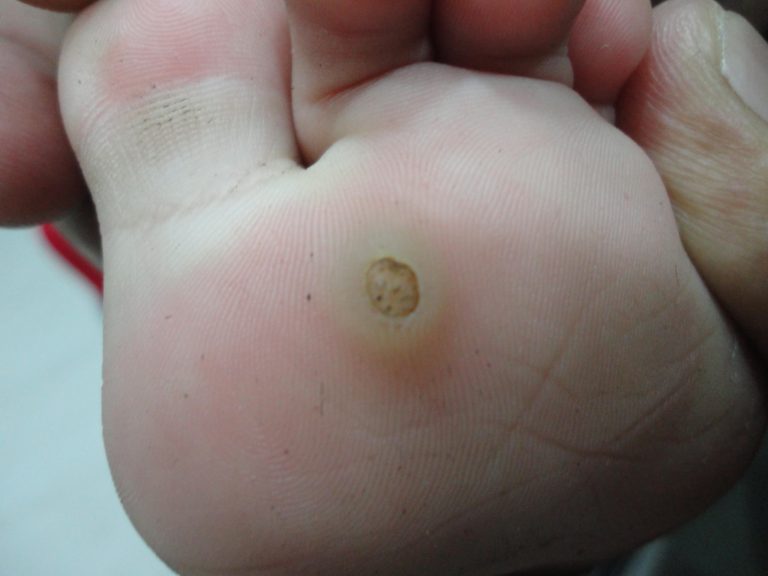 Plantar Warts Foot Warts Most Extensive Guide And Treatment Methods