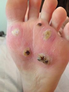 Multiple Foot Warts Infection