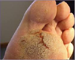 Plantar Warts Spread