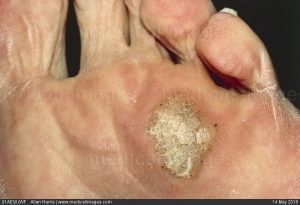 Foot Wart