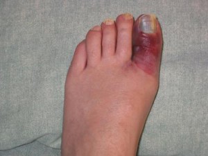 Toe Fractures in NYC