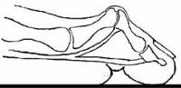 Hammertoe, hammer toe surgery, surgeon ny podiatrist foot doctor 10022 midtown nyc