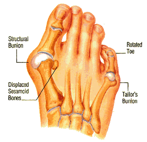 bunions ny foot doctor podiatrist bunionectomy tailor's bunion 10022