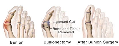 Bunion, Bunionectomy, Before and After Surgery Photos, Podiatrist NY Foot Doctor
