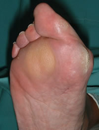 foot callus removal cream