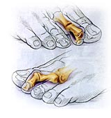 mallet, claw, and hammer toes