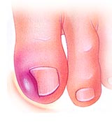 ingrown nails