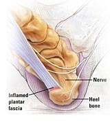 heel pain
