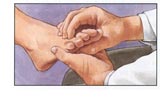 neuroma
