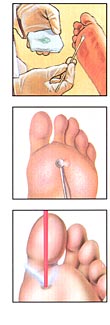 medication, curettage, laser - wart removal