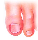 ingrown nails - nail removal