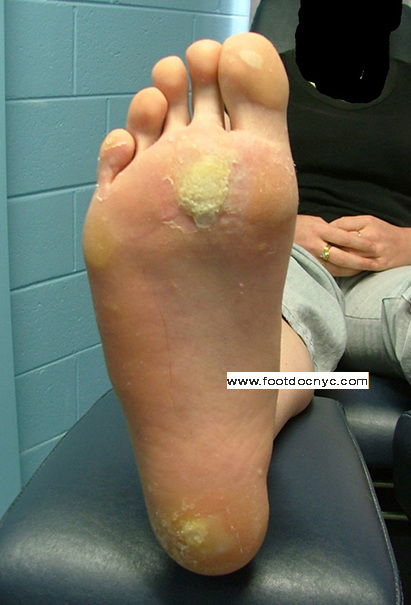 Papilloma foot removal