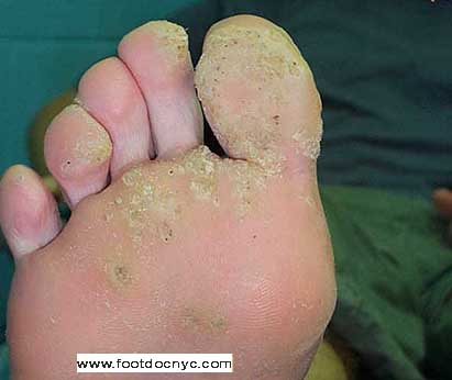 warts on foot removal
