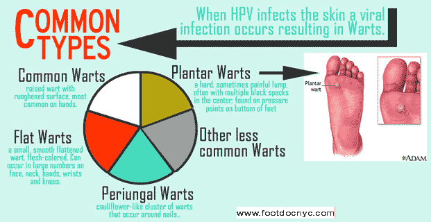 Plantar Warts Removal Doctor in NY