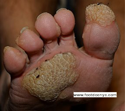 Wart on foot cut out