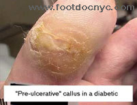 Calluses Specialist  Foot Callus Removal in Clifton and Wayne, NJ