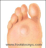 Foot Callus Removal: All You Need To Know - Northwich Foot Clinic
