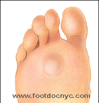 Foot Corn Removal by Cosmetic Podiatrist - Moore Foot and Ankle