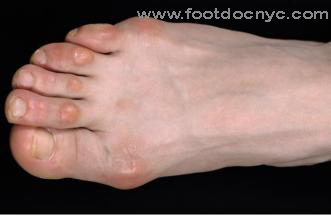 Foot Corn Removal by Cosmetic Podiatrist - Moore Foot and Ankle