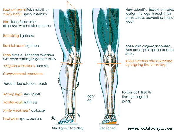 Foot Alignment with Orthotics