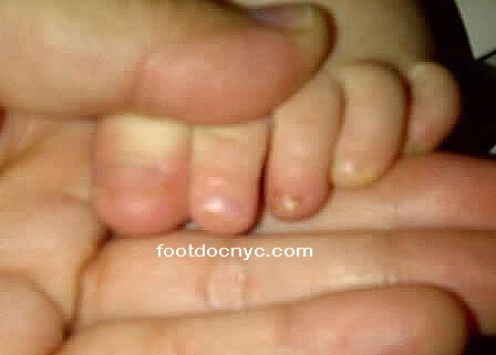 Fungal Toenails in Children