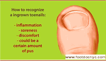 Ingrown Nail Symptoms
