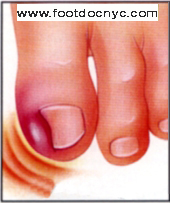 Ingrown Toenail