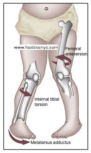 Intoeing metatarsus adductus