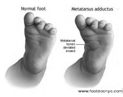 Metatarsus Adductus in Children