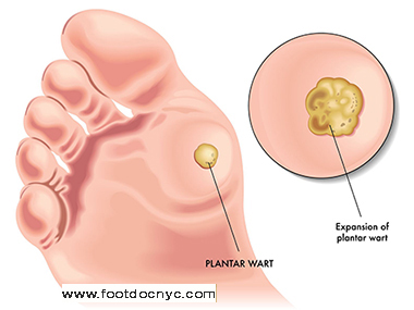 Plantar Warts on Kids Feet