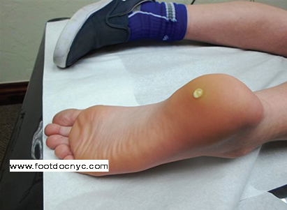 Example of Plantar Warts