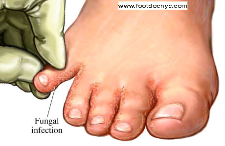 Athlete's foot orthotics store