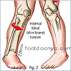 Tibial Torsion, Intoeing, Pigeon-Toed